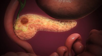 Pancreatic cancer in adults: when to offer surveillance