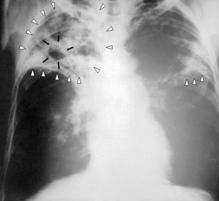 Nice | Tuberculosis (TB)