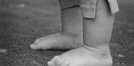 GP-Update | Normal variants of lower limb conditions in children