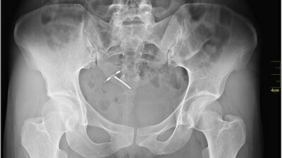 FSRH | Intrauterine contraception