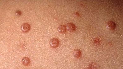 Molluscum contagiosum