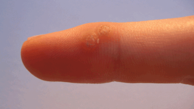 Viral warts