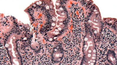 Nice | Coeliac disease