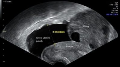 RCOG | Ovarian Hyperstimulation Syndrome