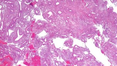 RCOG | Endometrial hyperplasia