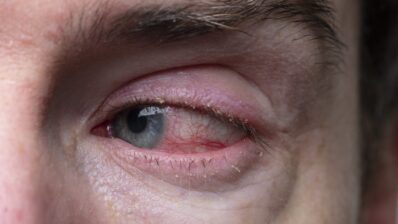 Blepharitis, flashers and floaters