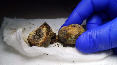 Nice | Gallstone disease