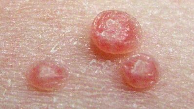 BASHH | Molluscum contagiosum
