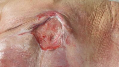 Nice | Pressure ulcers