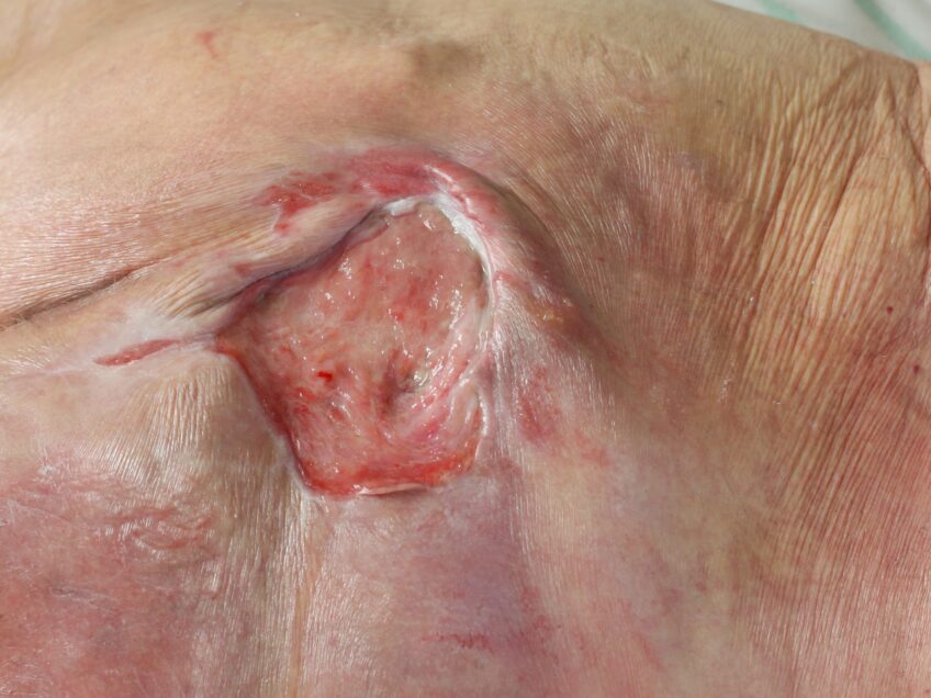 Nice | Pressure ulcers