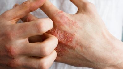 Baricitinib for dermatitis