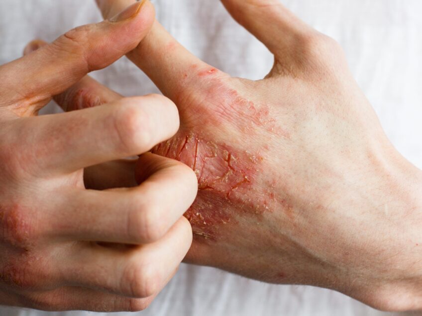 Baricitinib for dermatitis