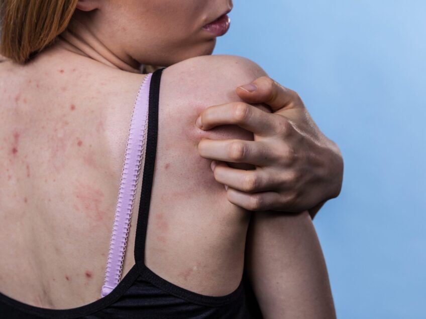 Acne and roaccutane (Nice update 2023)