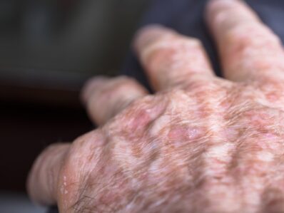 Podcast | Diagnosis and management of actinic keratosis by Dr Tony Downs