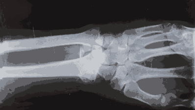 Suspected cancer: myeloma – updated guidance for GPs (Nice, 2025)